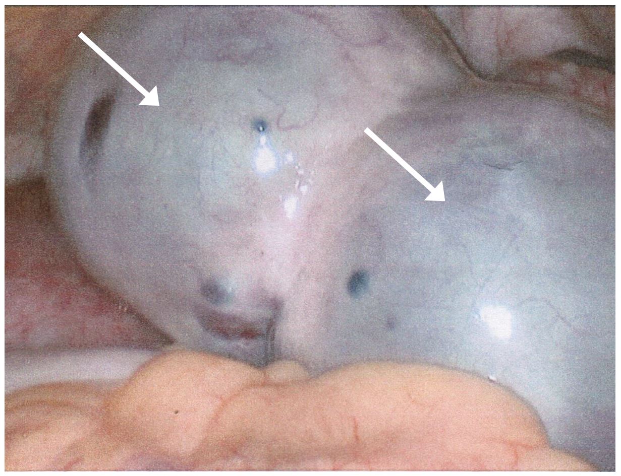 intermittent ovarian torsion