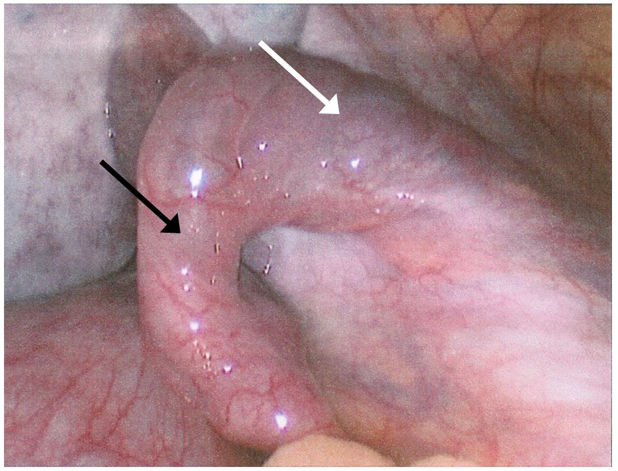 intermittent ovarian torsion