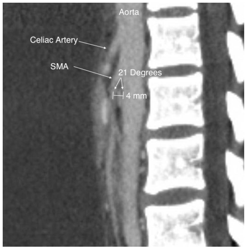 Superior Mesenteric Artery Syndrome Radiology