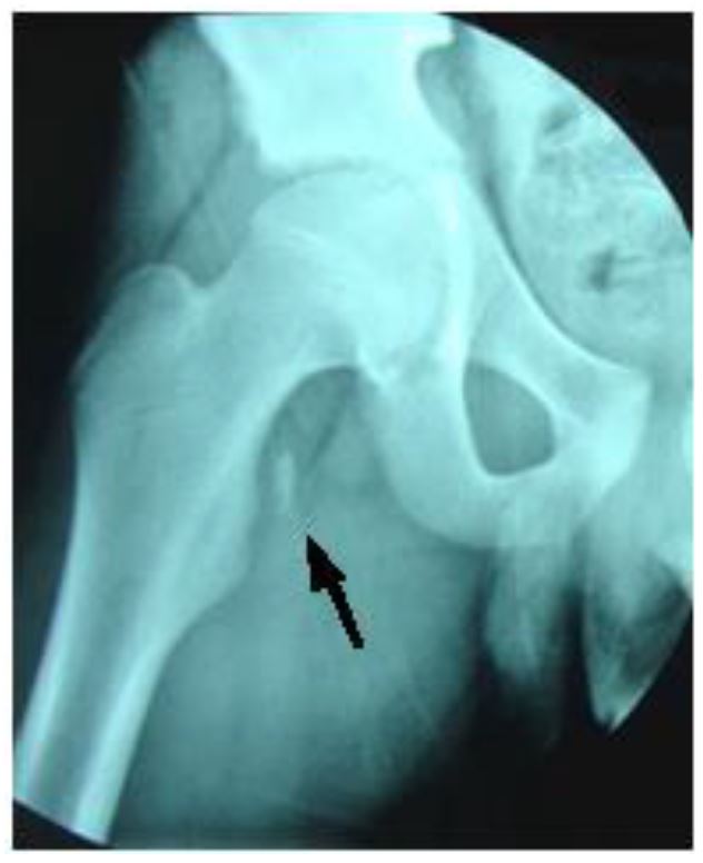 lesser trochanter fracture