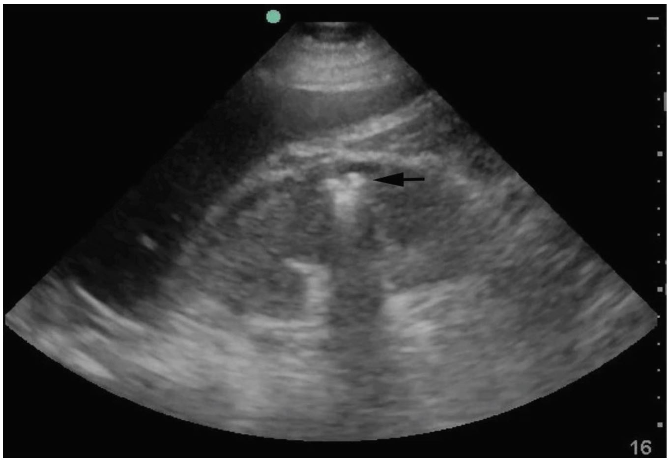 chronic pyelonephritis ultrasound