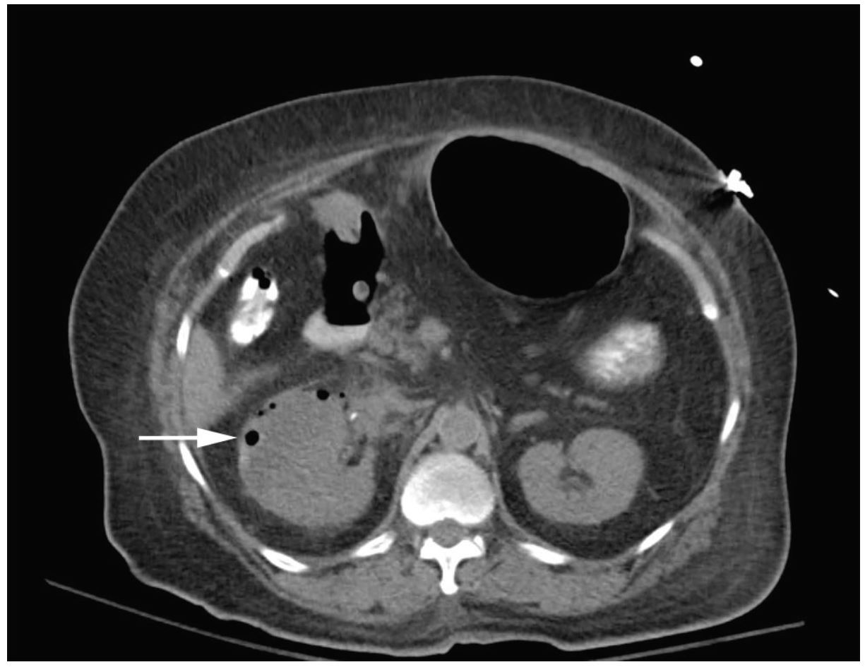 chronic pyelonephritis ultrasound