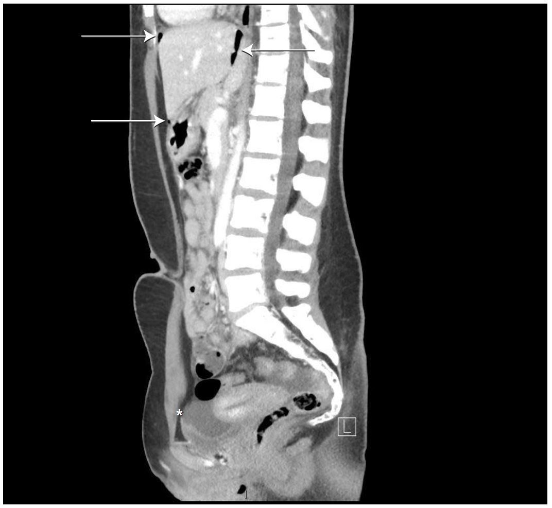 Acute Appendicitis Radiology Case Radiopaedia Org