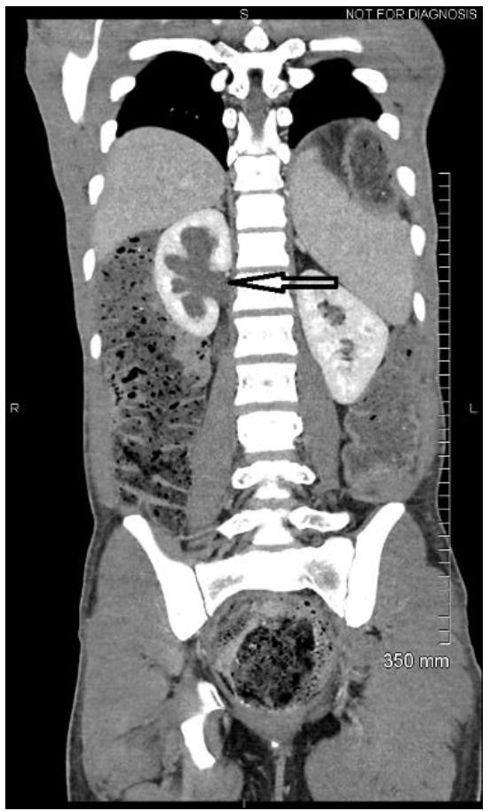 Fecal impaction, Radiology Reference Article