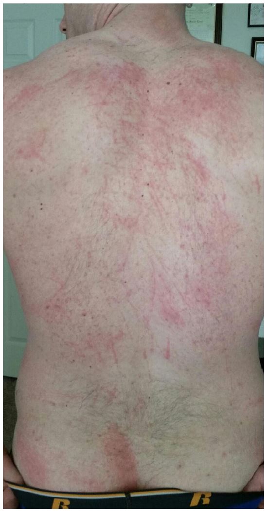 Flagellate Dermatitis A Culinary Flogging The Western Journal of