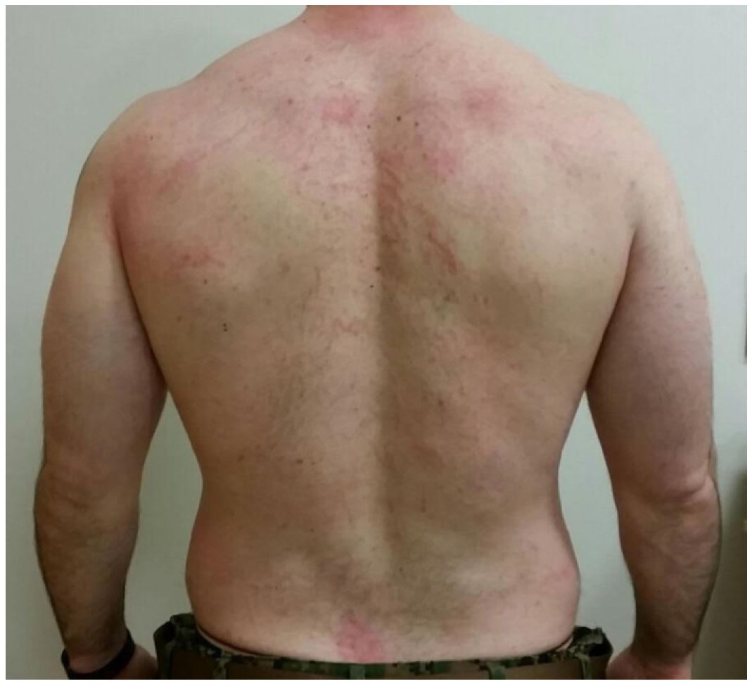 Flagellate Dermatitis: A Culinary Flogging - The Western Journal of ...