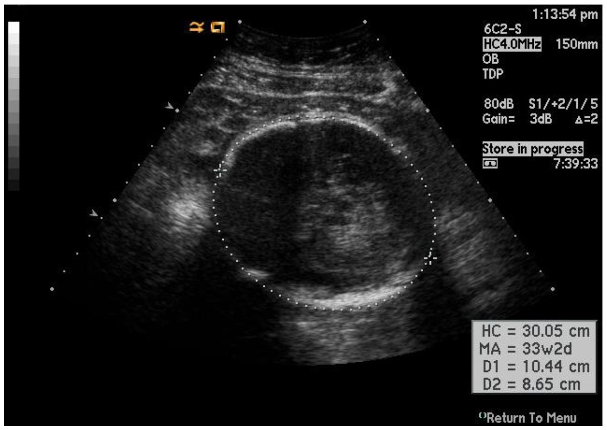 microcephaly ultrasound