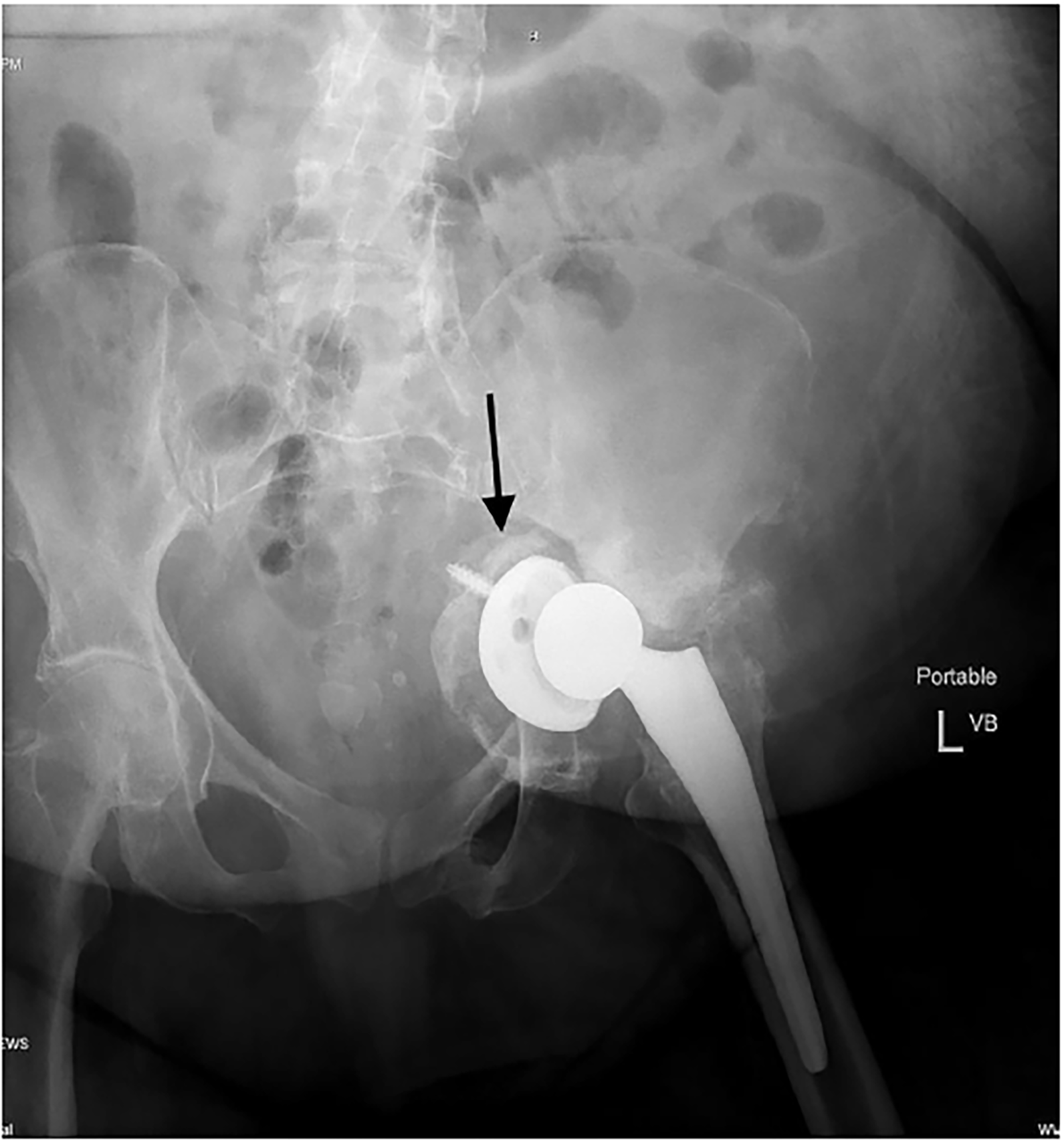 Traumatic Acetabular Protrusion The Western Journal Of Emergency Medicine