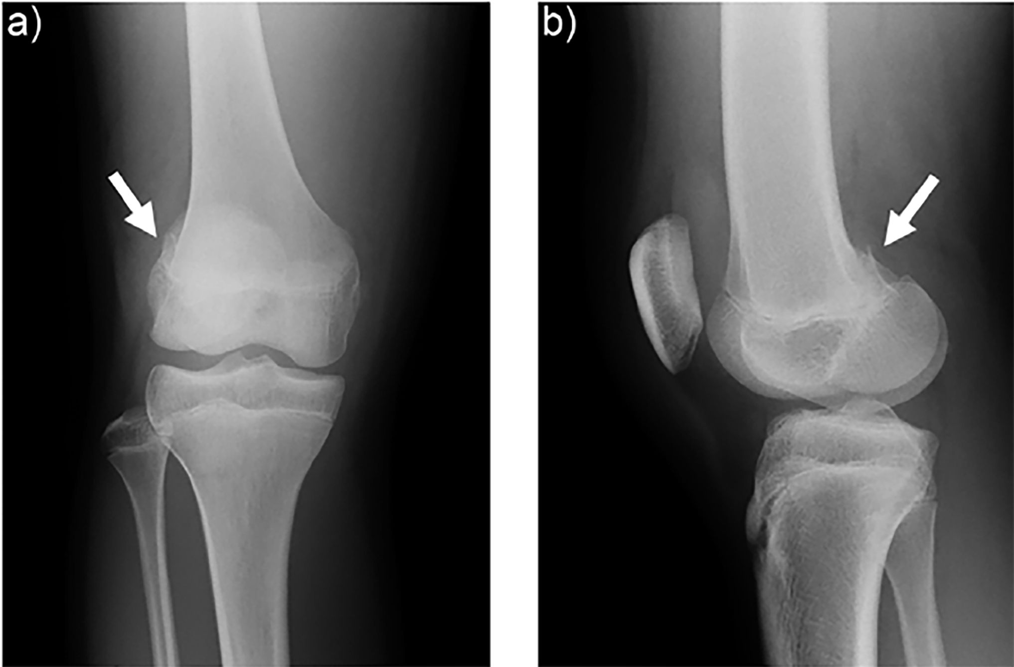 Lateral Femoral Condyle Avulsion Fracture My XXX Hot Girl
