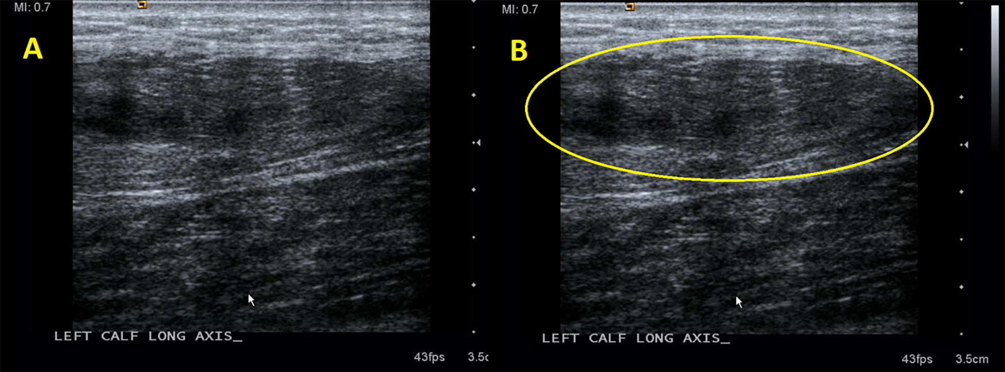 gastrocnemius tear ultrasound