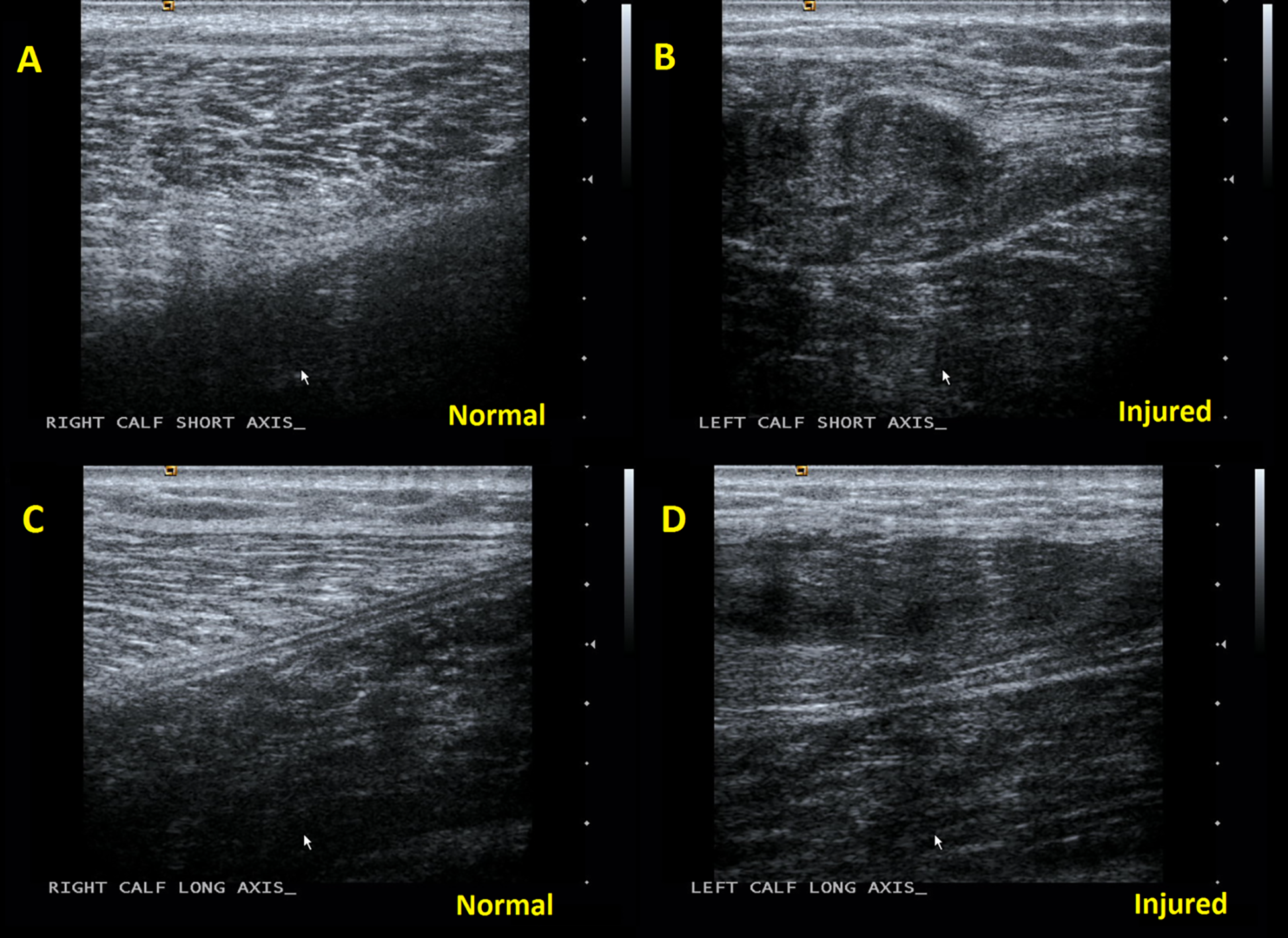 gastrocnemius tear ultrasound