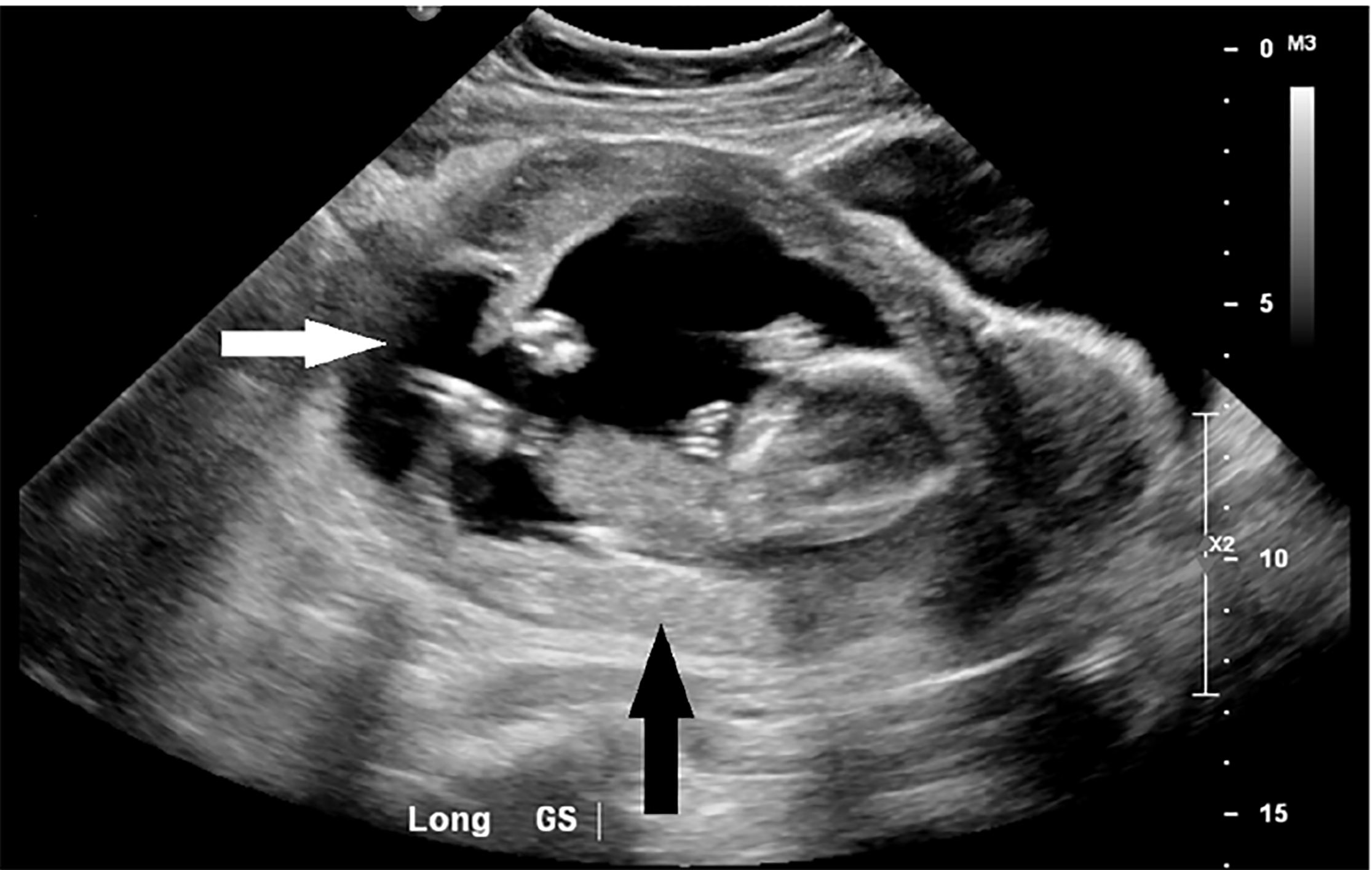 ruptured ectopic pregnancy ultrasound