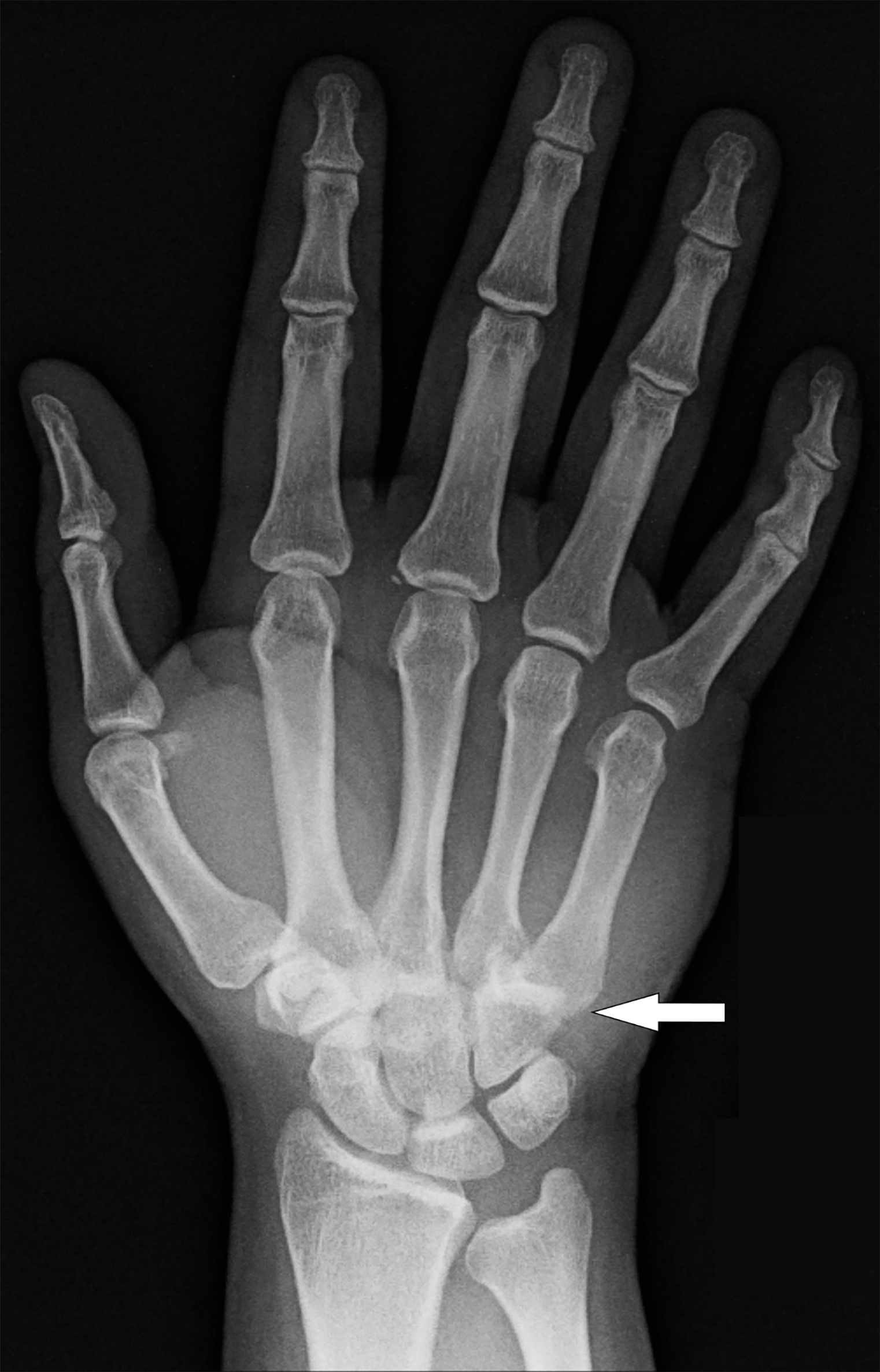 Metacarpophalangeal Joint Dislocation