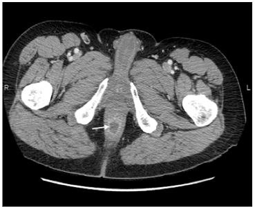 ischiorectal abscess mri