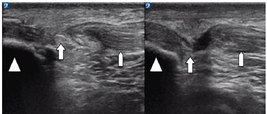 Patellar Tendon Tears - Orthopedic Specialists of Seattle