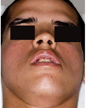 The Ultimate Poker Face A Case Report Of Facial Diplegia A Guillain Barre Variant The Western Journal Of Emergency Medicine