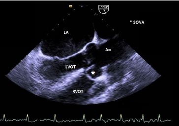 Ruptured Coronary Sinus Of Valsalva In The Setting Of A Supracristal Ventricular Septal Defect The Western Journal Of Emergency Medicine