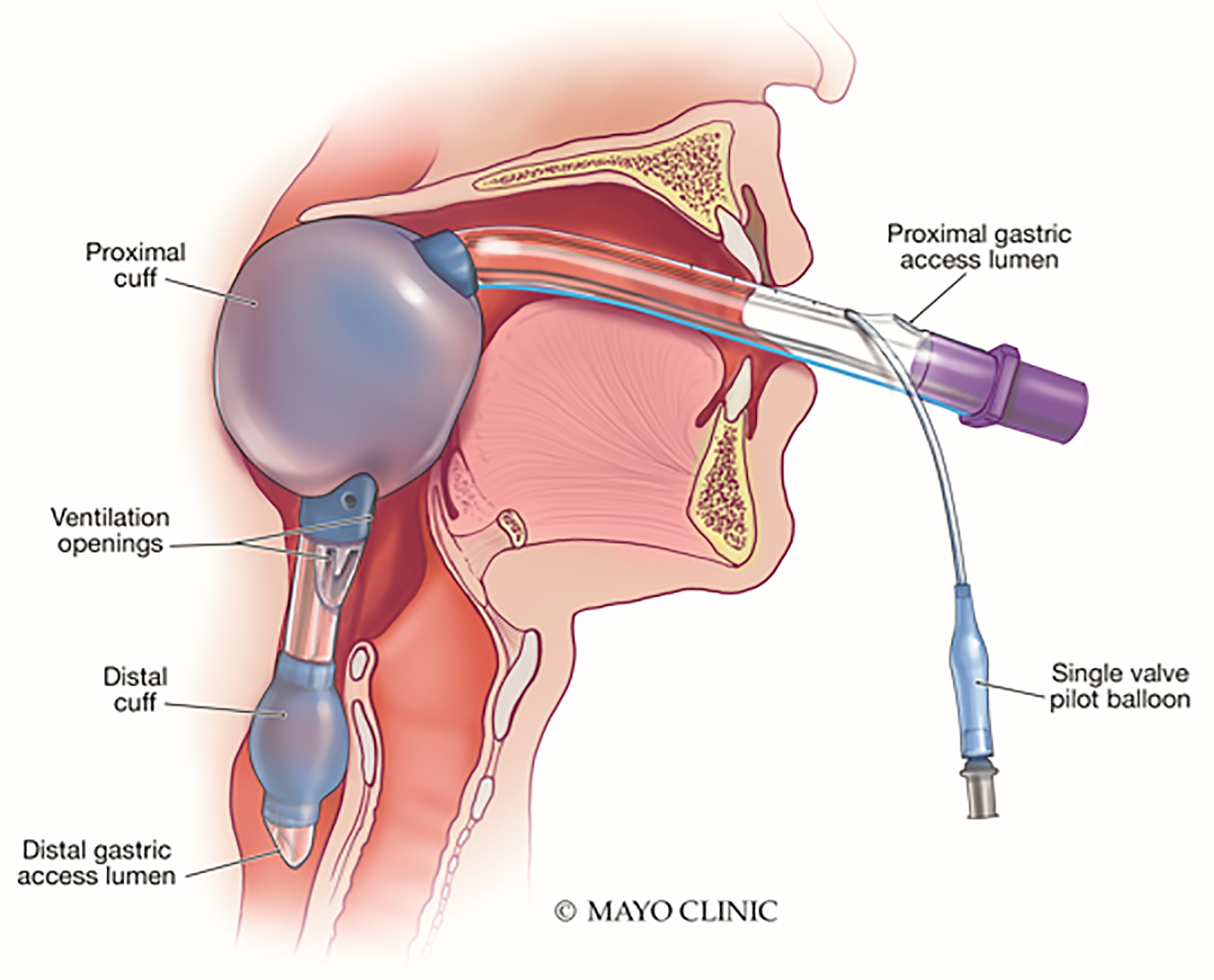 definitive-airway-management-of-patients-with-a-king-laryngeal-tube-in-place-in-the-covid-19