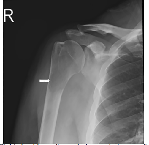 humerus x ray