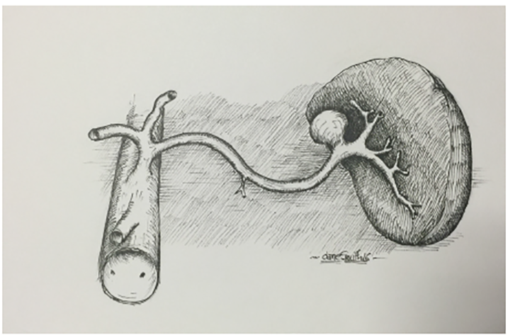 Ruptured Splenic Artery Aneurysm In The Postpartum Patient A Case