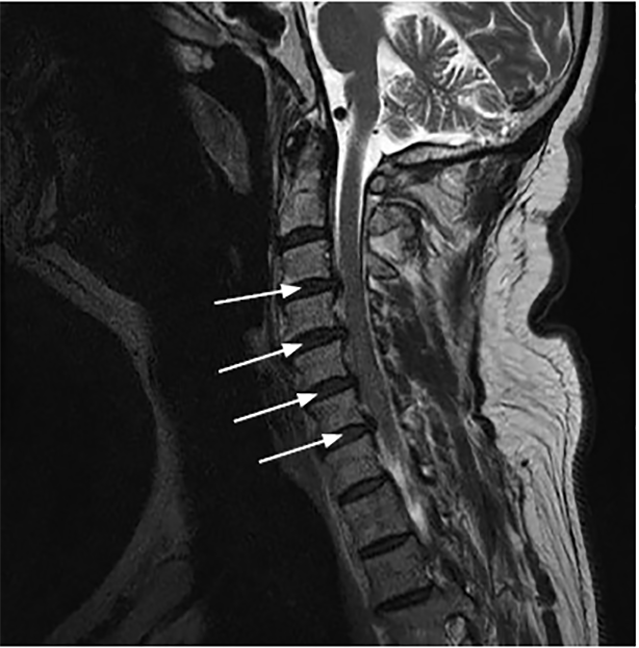 Post-traumatic Spinal Hematoma In Diffuse Idiopathic, 49% OFF