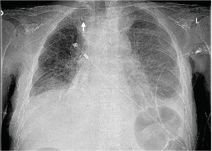 picc in innominate vein