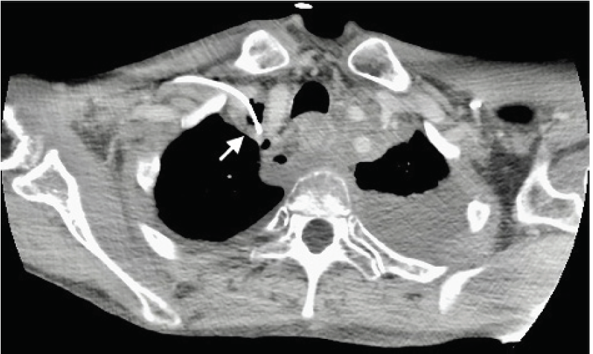 picc in innominate vein