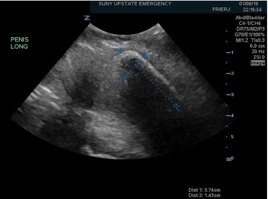 Tip Of The Iceberg Ultrasound