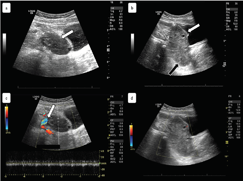 Laparoscopic Oophorectomy for Ovarian Torsion • Video •