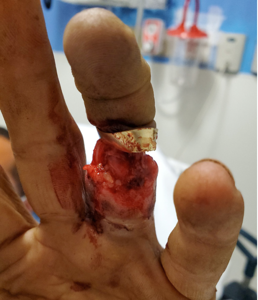 How Common Is Ring Avulsion Injuries