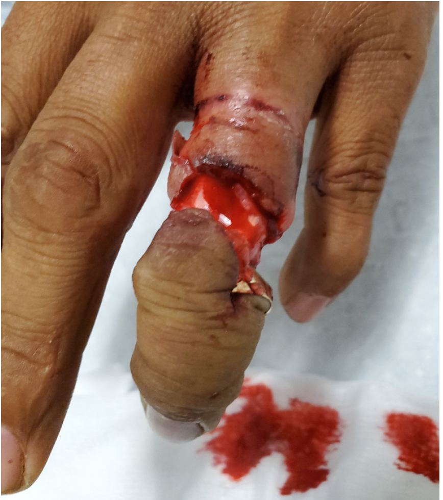 How Common Is Ring Avulsion Injuries