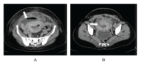 Post-abortion Complications: A Narrative Review for Emergency Clinicians -  The Western Journal of Emergency Medicine