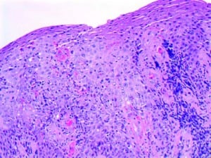 Hematoxylin and eosin stain of tissue biopsy specimen (40×) revealing epidermal hyperplasia with mild spongiosis, lymphocytic and eosinophilic exocytosis, degranulation of eosinophils at the dermoepidermal junction, and moderately dense superficial to deep perivascular lymphocytic infiltrate with scattered eosinophils.