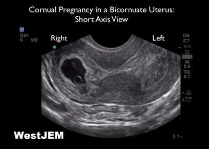 Emergency Ultrasound Identification of a Cornual Ectopic Pregnancy