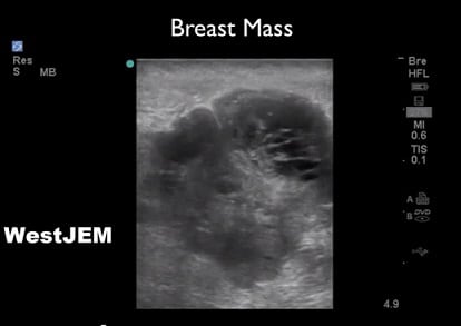 Evaluation of Breast Disorders with Ultrasound