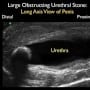 Ultrasound Diagnosis of Urethral Calculi