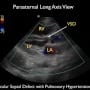 Pulmonary Hypertension, Hemoptysis and an Echocardiographic Finding of a Ventricular Septal Defect