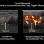 Thyroid Evaluation in a Patient with Thyrotoxicosis with Bedside Ultrasound