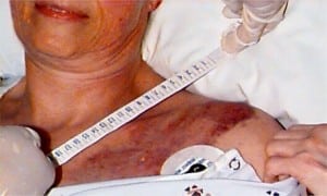 Figure 2. Seatbelt-related contusion and abrasion