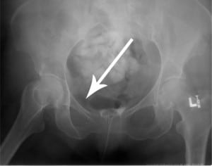 Figure 5. Pelvic x-ray with right sacral ala and pubic rami fracture
