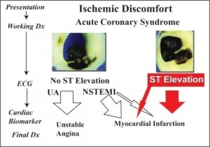 Figure 1. Spectrum of acute coronary syndromes. Adapted with permission from ©2004 American Heart Association, Inc.