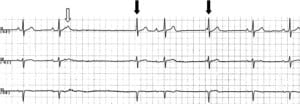 Figure 1. A rhythm strip demonstrating a 2.6 second pause. White arrow indicates a blocked premature atrial contraction. PR interval prolongation and junctional beats (black arrows) are also visible.