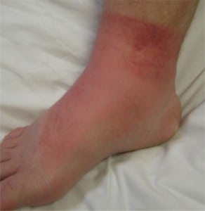 Figure 1. Medial aspect of the right foot with sock-like erythema