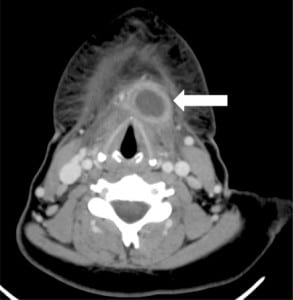 Figure. CT of the neck with contrast showing an enhancing, well-circumscribed lesion located in the anterior neck at the level of the thyroid cartilage.