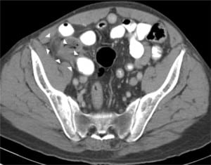 Figure 1. CT of the pelvis with oral and intravenous contrast showing inflammatory changes with a dilated 2 cm blind-ending tubular structure arising from the cecum inferior to the ileocecal valve.