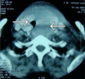 Figure. Neck CT demonstrating thyroid hematoma and displaced trachea.