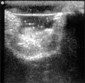 Figure 3. Vitrectomy-complete vitreous loss