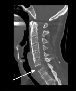 Figure 1. CT of cervical spine fracture in ankylosing spondylitis.