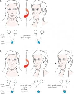 Figure 1. Head impulse test. A: The right ear has intact peripheral vestibular function. When the head is turned to the right, the vestibulo-ocular reflex moves the eyes to maintain visual fixation. B: The right ear now has impaired vestibular function. When the head is turned to the right, the eyes move with it, breaking visual fixation, and a refixation saccade is seen as the eyes dart back to the examiner’s face. This indicates a peripheral vestibular disorder on the right side.