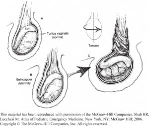 Figure 2. “Bell-clapper” deformity predisposing to testicular torsion
